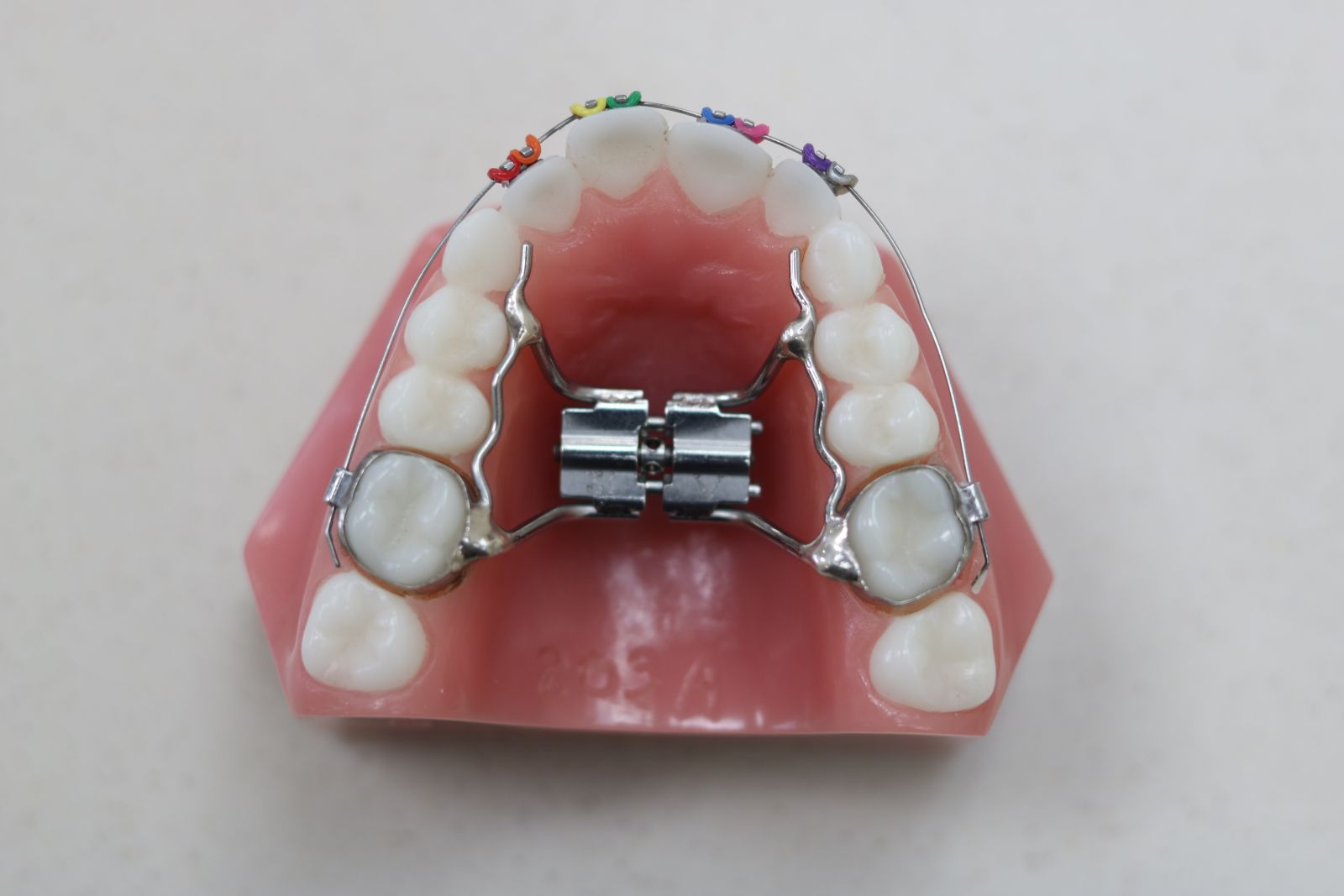 palatal expander model