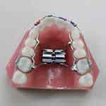 palatal expander